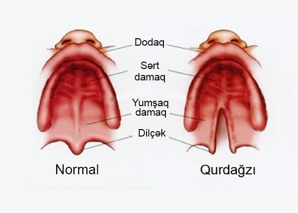 Loqoped İlahə Məmmədzadə rinolaliyadan danışdı Loqoped İlahə Məmmədzadə rinolaliyadan danışdı